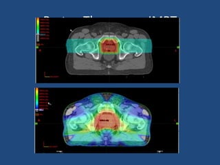 Proton Therapy vs. IMRT 
 