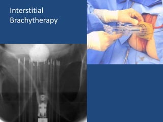 Interstitial 
Brachytherapy 
 