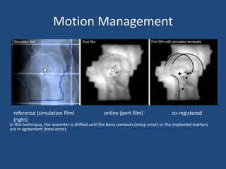 Motion Management 
reference (simulation film) online (port film) co-registered 
(right) 
In this technique, the isocenter is shifted until the bony contours (setup error) or the implanted markers 
are in agreement (total error). 
 