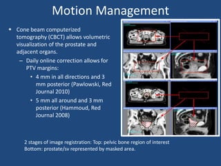 Motion Management 
 Cone beam computerized 
tomography (CBCT) allows volumetric 
visualization of the prostate and 
adjacent organs. 
– Daily online correction allows for 
PTV margins: 
• 4 mm in all directions and 3 
mm posterior (Pawlowski, Red 
Journal 2010) 
• 5 mm all around and 3 mm 
posterior (Hammoud, Red 
Journal 2008) 
2 stages of image registration: Top: pelvic bone region of interest 
Bottom: prostate/sv represented by masked area. 
 