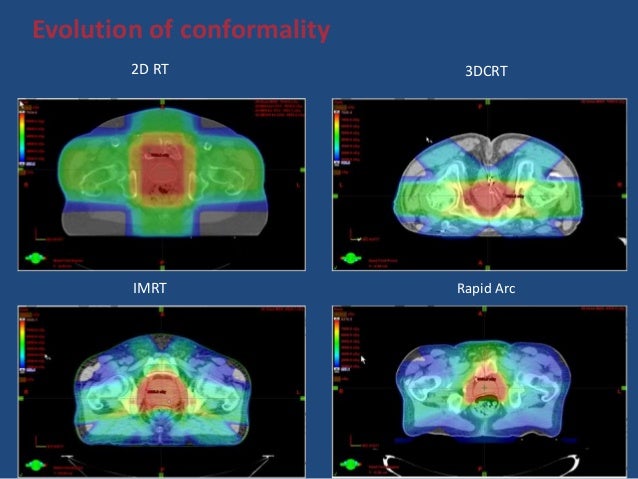 Radiation therapy in prostate cancer