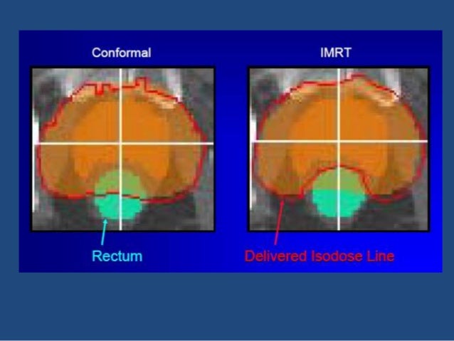 Radiation therapy in prostate cancer