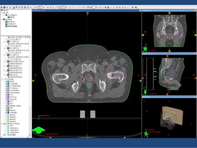 Radiation therapy in prostate cancer