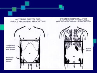 Radiation therapy in wilms tumour | PPT