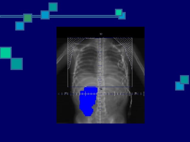 Radiation therapy in wilms tumour | PPT | Cancer | Diseases and Conditions