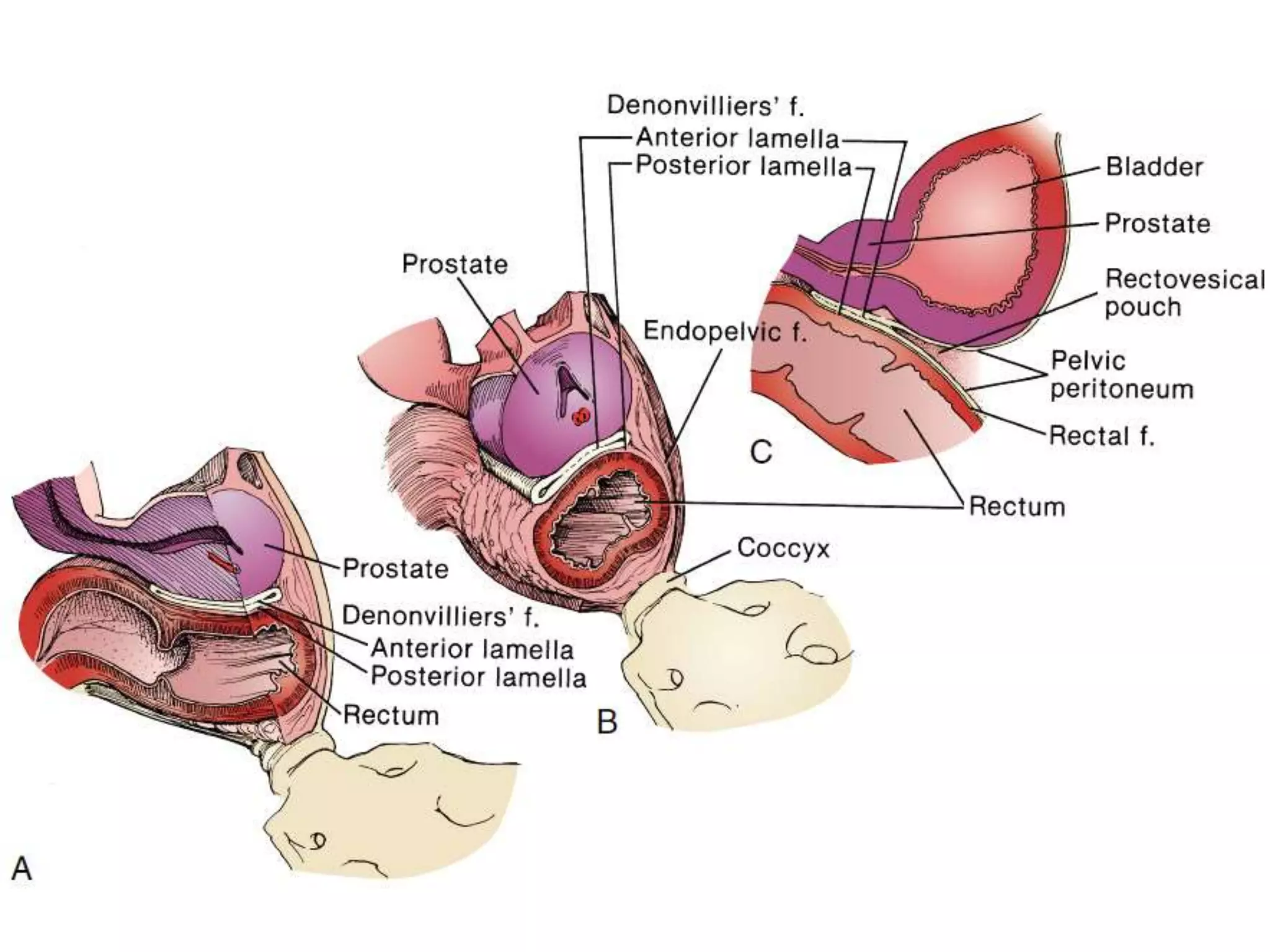 PROSTATECTOMY SURGICAL PROCEDURE visual data 4