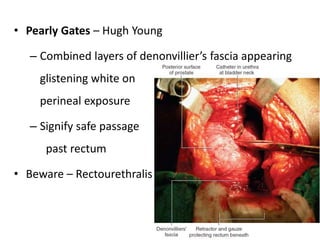 • Pearly Gates – Hugh Young
– Combined layers of denonvillier’s fascia appearing
glistening white on
perineal exposure
– Signify safe passage
past rectum
• Beware – Rectourethralis
 