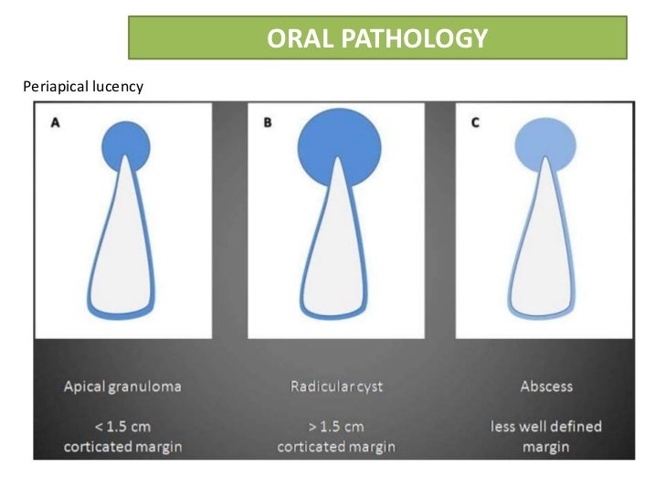 Radicular Cyst Vs Granuloma