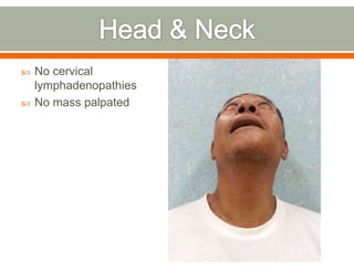  No cervical
lymphadenopathies
 No mass palpated
 