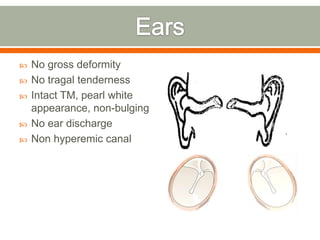  No gross deformity
 No tragal tenderness
 Intact TM, pearl white
appearance, non-bulging
 No ear discharge
 Non hyperemic canal
 