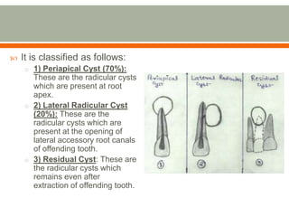  It is classified as follows:
o 1) Periapical Cyst (70%):
These are the radicular cysts
which are present at root
apex.
o 2) Lateral Radicular Cyst
(20%): These are the
radicular cysts which are
present at the opening of
lateral accessory root canals
of offending tooth.
o 3) Residual Cyst: These are
the radicular cysts which
remains even after
extraction of offending tooth.
 