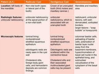Patient (A.F.) Radicular Cyst Dentigerous Cyst Ameloblastoma
Location: left body of
the mandible
Non-vital tooth (apex
or lateral part of the
tooth)
Crown of an unerupted
tooth (third molars and
maxillary canines )
Mandible and maxillary
area
Radiologic features:
unilocular radiolucency
unilocular radiolucency
at the apical portion of
a non-vital tooth
unilocular
radiolucency, which is
associated with an
unerupted tooth
radiolucent, unilocular
lesions, with well-
demarcated, corticated
borders;
larger lesions : “soap
bubble” or honeycomb
Microscopic features luminal lining:
nonkeratinized
stratified squamous
epithelium
odontogenic rests are
rarely seen in the cyst
wall
Cholesterol slits,
foreign body giant
cells, and hemosiderin
deposits are common
findings.
luminal lining:
nonkeratinized
stratified squamous
epithelium
Odontogenic rests are
scattered within the
connective tissue
Cholesterol slits and
their associated
multinucleated giant
cells may be present
columnar basilar cells,
palisading of basilar
cells, polarization of
basilar layer nuclei
away from the
basement membrane,
hyperchromatism of
basal cell nuclei in the
epithelial lining, and
subnuclear
vacuolization of the
cytoplasm of the basal
cells
 