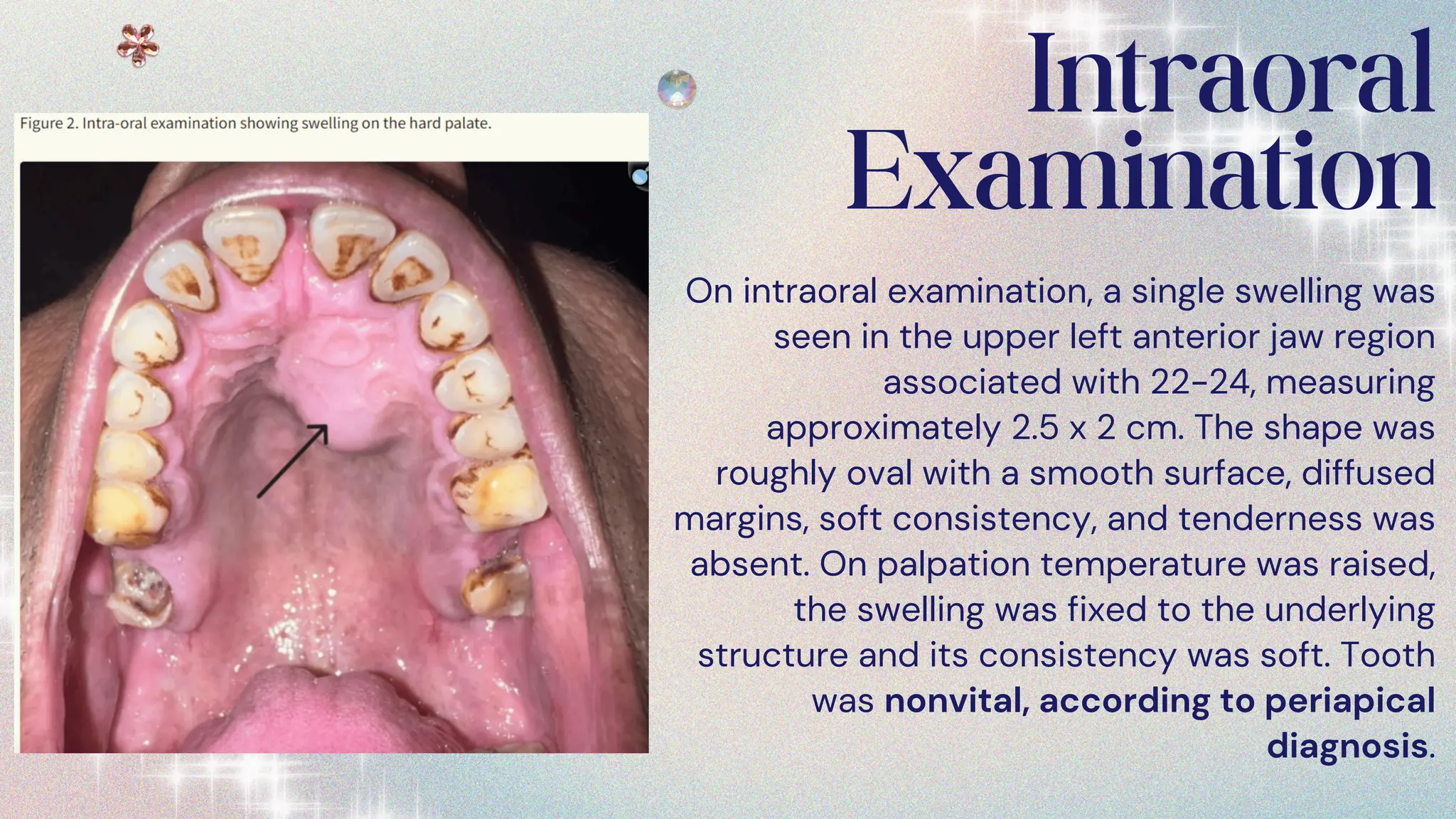 Radicular Cyst Case Presentation - Dentistry.pdf