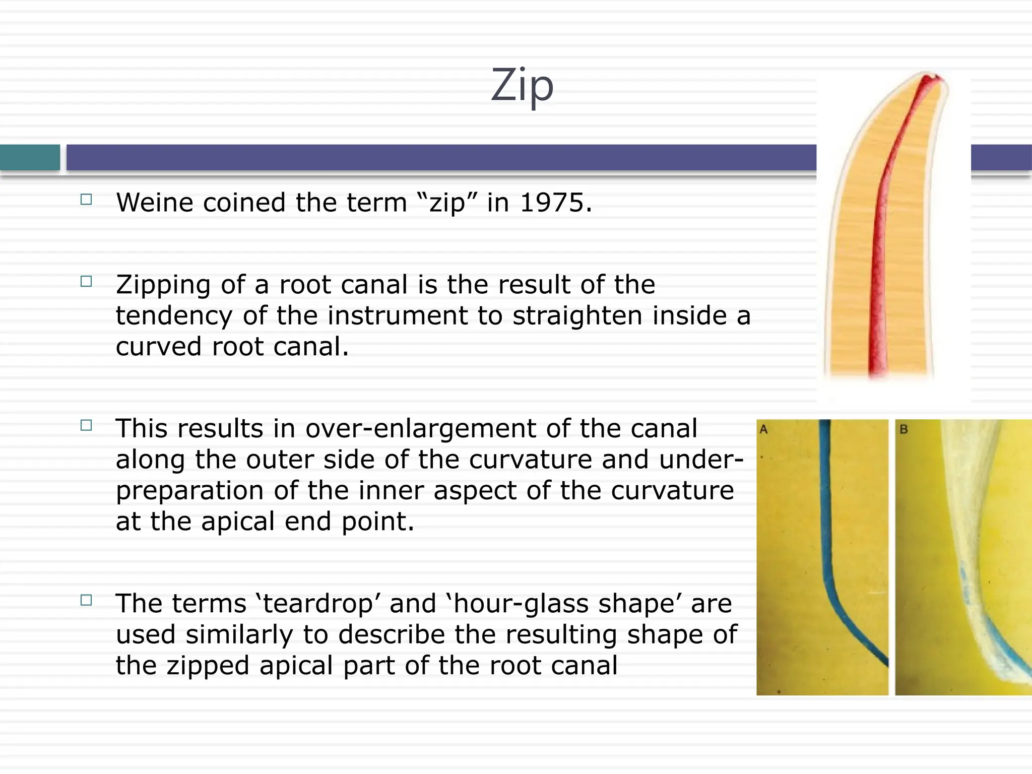  Weine coined the term “zip” in 1975.
 Zipping of a root canal is the result of the
tendency of the instrument to straighten inside a
curved root canal.
 This results in over-enlargement of the canal
along the outer side of the curvature and under-
preparation of the inner aspect of the curvature
at the apical end point.
 The terms ‘teardrop’ and ‘hour-glass shape’ are
used similarly to describe the resulting shape of
the zipped apical part of the root canal
Zip
 