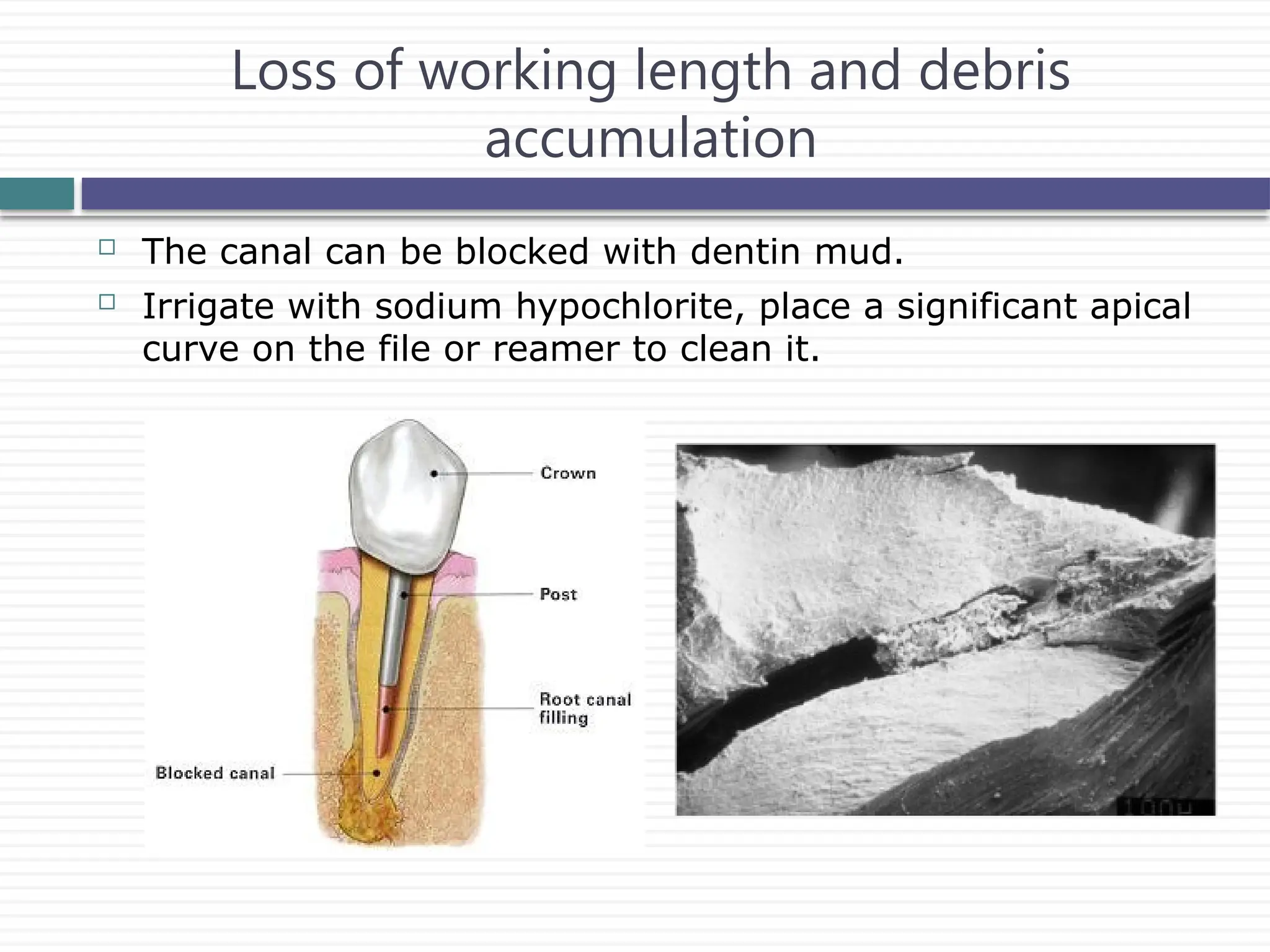 Loss of working length and debris
accumulation
 The canal can be blocked with dentin mud.
 Irrigate with sodium hypochlorite, place a significant apical
curve on the file or reamer to clean it.
 