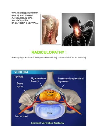 www.drsandeepagrawal.com!
www.agrasenortho.com!
AGRASEN HOSPITAL!
Gondia Vidarbha !
DR SANDEEP C AGRAWAL!
!
!
!
!
!
!
RADICULOPATHY :
Radiculopathy is the result of a compressed nerve causing pain that radiates into the arm or leg.
 