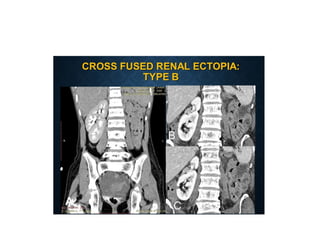 Renal Rotation Radiology radilogical imaging in common kidney pathologies.pptx