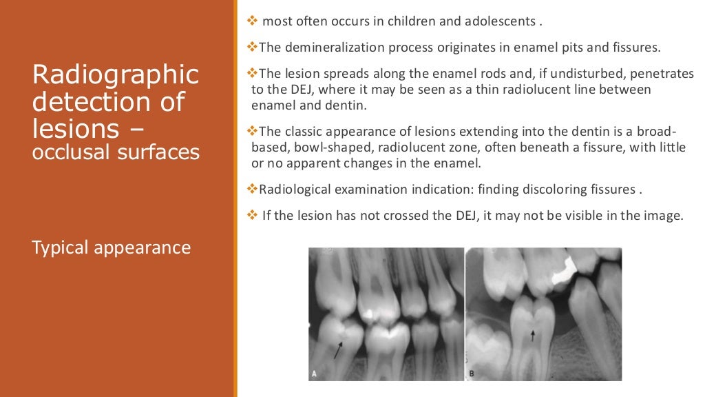 radiographic of interpretation of dental caries