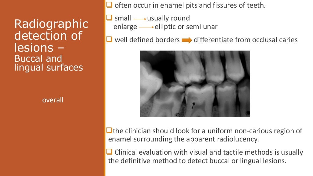radiographic of interpretation of dental caries