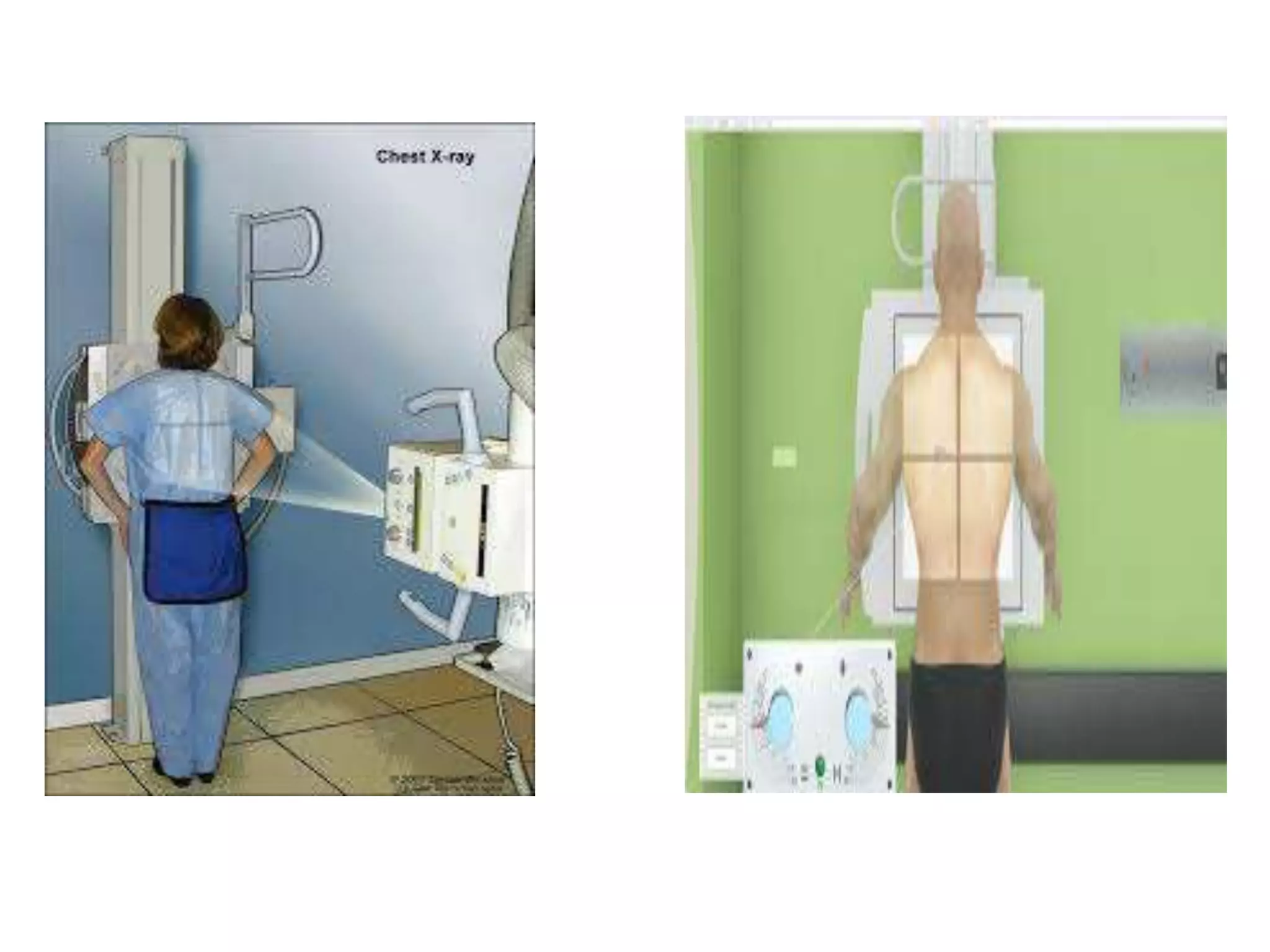 basics of chest xray | PPTX