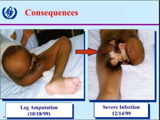 Consequences Leg Amputation (10/18/99) Severe Infection 12/14/99 
