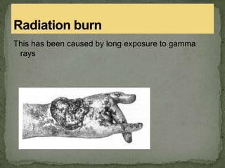 This has been caused by long exposure to gamma
rays
 