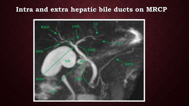 Radioanatomy of biliary system | PPTX | Digestive Disorders | Diseases ...