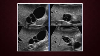 Radioanatomy of biliary system | PPTX