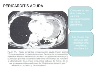 PERICARDITIS AGUDA Clínicamente hay dolor torácico, cambios electrocardiográficos y roce pericárdico. Las causas mas comunes son: idiopática, viral, neoplásica, bacteriana, tbc. 