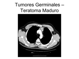 Tumores Germinales – Teratoma Maduro 