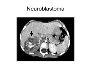 Neuroblastoma 