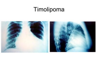 Timolipoma 