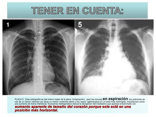PLACA 5 : Esta radiografía es del mismo sujeto de la placa 1(inspiración) , pero fue tomada  en espiración : los pulmones se ven de un menor volumen por tener un menor contenido aéreo y los vasos, aglomerados en un área mas restringida, impresionan como una aumento de trama intersticial. El ascenso diafragmático reduce la elongación del mediastino que aparece ensanchado con  aumento aparente de tamaño del corazón porque este está en una posición más horizontal. 