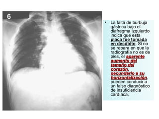 La falta de burbuja gástrica bajo el diafragma izquierdo indica que esta  placa fue tomada en decúbito . Si no se repara en que la radiografía no es de pies, el  aparente aumento del tamaño del corazón, secundario a su horizontalización , pueden conducir a un falso diagnóstico de insuficiencia cardíaca. 