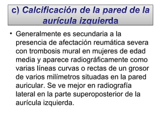 Generalmente es secundaria a la presencia de afectación reumática severa con trombosis mural en mujeres de edad media y aparece radiográficamente como varias líneas curvas o rectas de un grosor de varios milímetros situadas en la pared auricular. Se ve mejor en radiografía lateral en la parte superoposterior de la aurícula izquierda. 