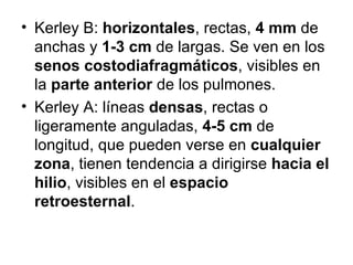 Kerley B:  horizontales , rectas,  4 mm  de anchas y  1-3 cm  de largas. Se ven en los  senos costodiafragmáticos , visibles en la  parte anterior  de los pulmones. Kerley A: líneas  densas , rectas o ligeramente anguladas,  4-5 cm  de longitud, que pueden verse en  cualquier zona , tienen tendencia a dirigirse  hacia el hilio , visibles en el  espacio retroesternal .  