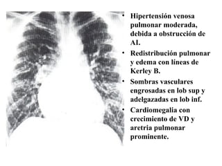Hipertensión venosa pulmonar moderada, debida a obstrucción de AI. Redistribución pulmonar y edema con líneas de Kerley B. Sombras vasculares engrosadas en lob sup y adelgazadas en lob inf. Cardiomegalia con crecimiento de VD y aretria pulmonar prominente. 