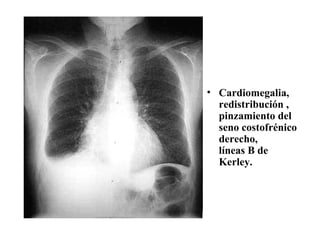 Cardiomegalia, redistribución , pinzamiento del seno costofrénico derecho, líneas B de Kerley. 