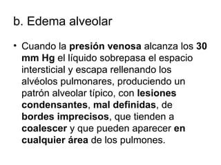 b.  Edema alveolar Cuando la  presión venosa  alcanza los  30 mm Hg  el líquido sobrepasa el espacio intersticial y escapa rellenando los alvéolos pulmonares, produciendo un patrón alveolar típico, con  lesiones condensantes ,  mal definidas , de  bordes imprecisos , que tienden a  coalescer  y que pueden aparecer  en cualquier área  de los pulmones.  