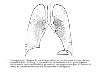 Edema pulmonar. El edema del intersticio se traduce por borramiento de la trama vascular y presencia de líneas de Kerley. El edema alveolar da sombras de relleno que se disponen simétricamente alrededor de los hilios, produciendo una imagen en mariposa. El aumento de tamaño del corazón indica que en este caso el edema es cardiogénico.  