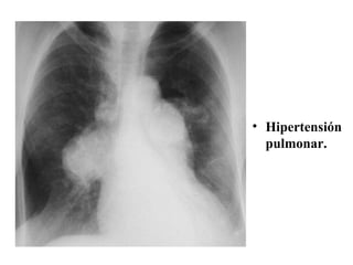 Hipertensión pulmonar. 