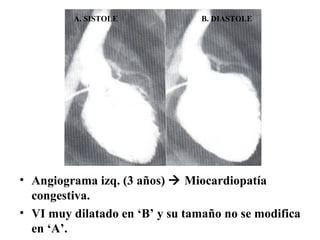 Angiograma izq. (3 años)    Miocardiopatía congestiva. VI muy dilatado en ‘B’ y su tamaño no se modifica en ‘A’. A. SISTOLE B. DIASTOLE 