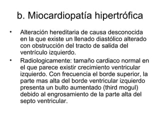 b. M iocardiopatía hipertrófica Alteración hereditaria de causa desconocida en la que existe un llenado diastólico alterado con obstrucción del tracto de salida del ventrículo izquierdo.  Radiologicamente: tamaño cardiaco normal en el que parece existir crecimiento ventricular izquierdo. Con frecuencia el borde superior, la parte mas alta del borde ventricular izquierdo presenta un bulto aumentado (third mogul) debido al engrosamiento de la parte alta del septo ventricular. 