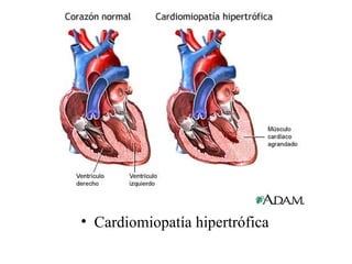 Cardiomiopatía hipertrófica 