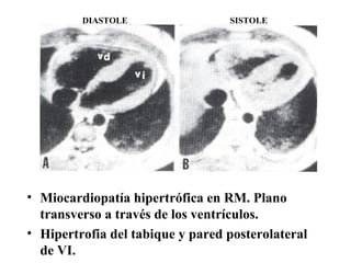 Miocardiopatía hipertrófica en RM. Plano transverso a través de los ventrículos. Hipertrofia del tabique y pared posterolateral  de VI. DIASTOLE SISTOLE 