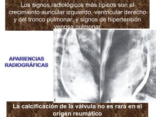 Los signos radiológicos más típicos son el crecimiento auricular izquierdo, ventricular derecho y del tronco pulmonar, y signos de hipertensión venosa pulmonar La calcificación de la válvula no es rara en el origen reumático 