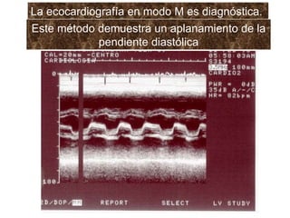 La ecocardiografía en modo M es diagnóstica.  Este método demuestra un aplanamiento de la pendiente diastólica 