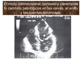 El modo bidimensional demuestra claramente lo cambios patológicos en las valvas, el anillo y las cuerdas tendinosas. 