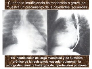 Cuando la insuficiencia es moderada a grave, se muestra un crecimiento de la cavidades izquierdas En insuficiencia de larga evolución y de aumento crónico de la resistencia vascular pulmonar, la radiografía muestra hallazgos de hipertensión pulmonar 