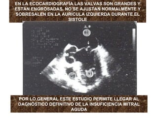 EN LA ECOCARDIOGRAFÍA LAS VALVAS SON GRANDES Y ESTÁN ENGROSADAS. NO SE AJUSTAN NORMALMENTE Y SOBRESALEN EN LA AURÍCULA IZQUIERDA DURANTE EL SISTOLE POR LO GENERAL ESTE ESTUDIO PERMITE LLEGAR AL DAGNÓSTICO DEFINITIVO DE LA INSUFICIENCIA MITRAL AGUDA 